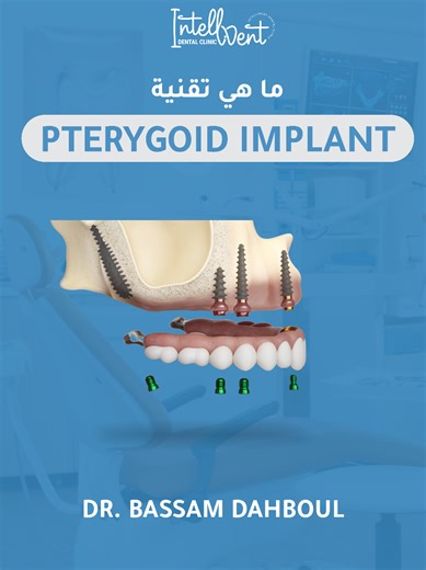 🦷 زراعة الأسنان الجناحية (Pterygoid Implants): الحل الأمثل لحالات فقدان العظم الشديد! إذا قيل لك من قبل أنك لا تستطيع الحصول على زراعة الأسنان بسبب فقدان العظم في الفك العلوي، فإن زراعة الأسنان الجناحية قد تكون الحل المثالي لك! على عكس الزراعة التقليدية التي تحتاج إلى عظم فك قوي، يتم تثبيت الزرعات الجناحية في العظم الجناحي الكثيف، مما يوفر دعماً قوياً للأسنان الثابتة دون الحاجة إلى تطعيم عظمي. 💡 من يحتاج إلى زراعة الأسنان الجناحية؟ ✔️ الأشخاص الذين يعانون من فقدان شديد للعظم في الفك العلوي ✔️ 