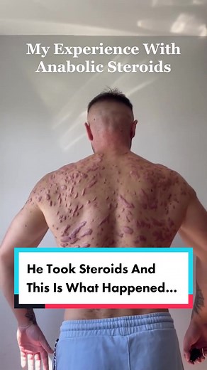 He took steroids and this is what happened to his skin. In today's YouTube video I checked out @davehartrey recent post where he showed the aftermath of his steroid use, listened to him describe his experience with anabolics and acne, as well as if he regrets it. I gave my thoughts on it, and made a hit list of every acne treatment I could think of, as well as enhanced strategies for mitigation. While there are very effective treatment options for many people and most will not experience acne se