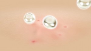 3d Animation Skin Acne Repair Effect Stock Footage Video (100% Royalty-free) 1057062878 | Shutterstock