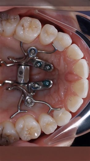 Dr. Svitlana Koval on Instagram: "This is a case where the patient had premolar extractions before, attempted removable expansion appliance ( no brands here) , ended up with multiple spaces between the back teeth. To start with our Midfacial expansion, we went with our 3D guided midpalatal piezocorticotomy assisted MARPE approach, did not put any framework against any of the back teeth to prevent further flaring. The power chains were used to upright teeth previously flared with a removable appl
