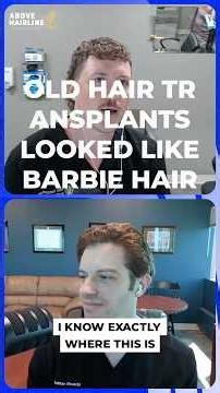 Why Old Hair Transplants Looked Like Doll Hair