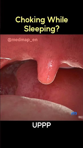 What's Sleep Apnea? | 3D Animation