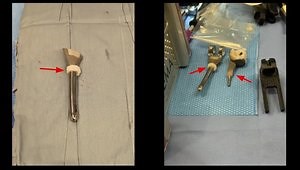 Hybrid Total Elbow Arthroplasty for Chronic Nonunion of a Distal Humerus Fracture