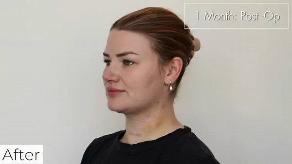 Submental Lipo Transformation✨ | Chin Liposuction with Dr. JoAnna Nguyen