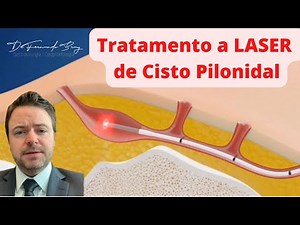 Tratamento a Laser de Cisto Pilonidal