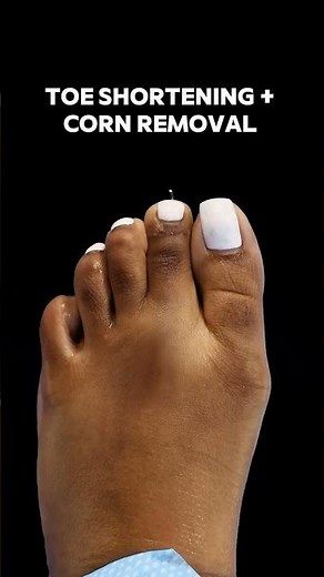 💉Treatment Minimally Invasive Toe Shortening & Corn Removal Surgery 🎯Purpose Alleviate pain,