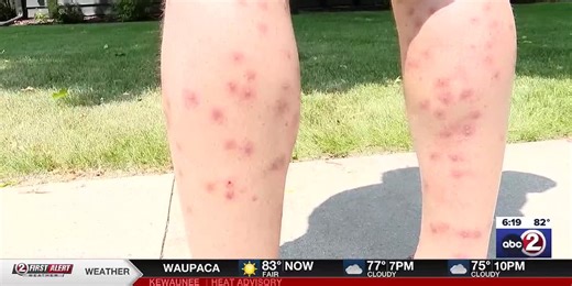 Blue-green algae giving swimmers rashes in Lake Winnebago