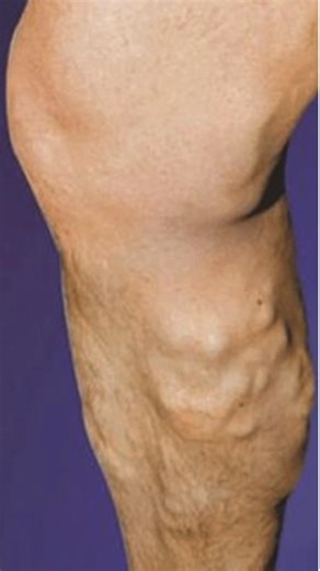 ℹ️ 𝐁𝐫𝐮𝐧𝐬𝐰𝐢𝐜𝐤 & 𝐒𝐮𝐫𝐫𝐨𝐮𝐧𝐝𝐢𝐧𝐠 𝐀𝐫𝐞𝐚! Many women suffer from Varicose Veins, Spider Veins, and vein disease. But there is good news… We are now offering a New Vein Screening Program, available in-person, and it's 100% FREE. Take action and find out about your vein health today. 👉 https://cvr.healthcareconnection.net/brunswick-georgia-vso Center for Vein Restoration is America’s largest Physician-led Vein Center company with 100 locations and a 98% satisfaction rating. As the 