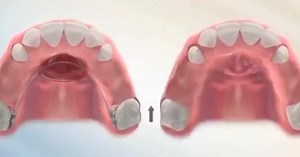 The Nance appliance is used to prevent upper molars from moving or rotating forward due to early loss of primary molars(baby teeth). It can also be use as a space maintainer. #harvandental | Harvan Dental Clinic | Facebook