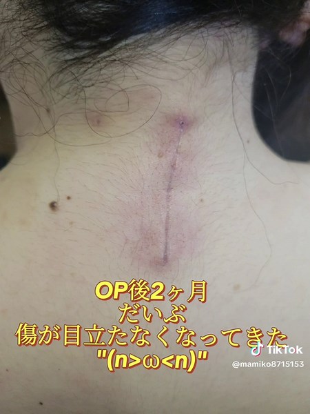 胸膜癒着術に関するお勧め情報