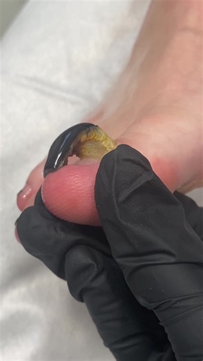 Toenail Transformation with Gel Reconstruction