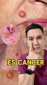 The most common type of cancer in the world (basal cell carcinoma). #dermatology #dermatologist