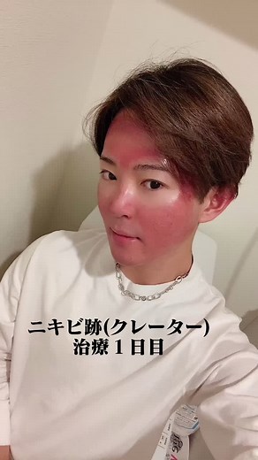 治療１日目でグロいニキビ跡(クレーター)対処法！