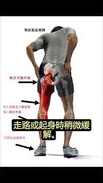 梨狀肌症候群！ 假性坐骨神經痛 名醫教你2種治療方法 腰椎小面關節注射+針刀微創/徐上德醫師