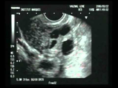 INSTITUT MARQUÈS - La estimulacion ovárica