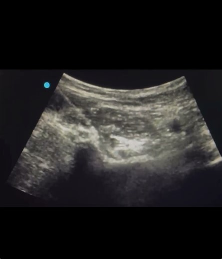 PENG block for hip Pain