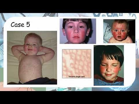 Paediatrics - Common childhood exanthema