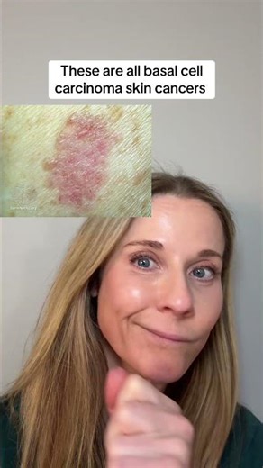 These are all examples of basal cell carcinoma (BCC) skin cancer. 🤯#skincancer #bcc