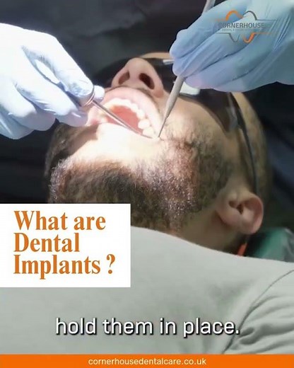 What Are Dental Implants? | Expert Guide to Benefits & Procedure Explained Clearly