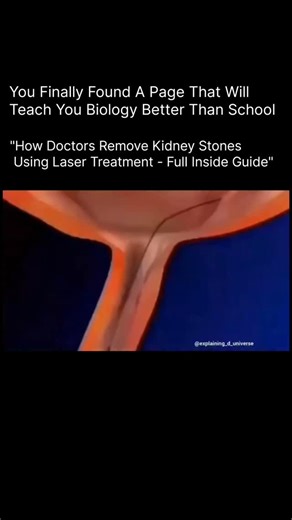 HEALTH | MEDICAL | BIOLOGY | A full guide on how kidney stones are removed using modern medical techniques. Doctors use different methods depending on the size, shape,... | Instagram