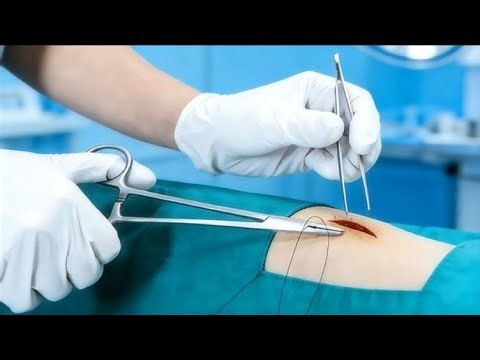 SUTURING TECHNIGUES: SIMPLE INTERRUPTED SUTURE