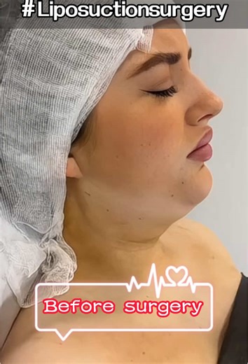 Liposuction Transformations: Before and After Results