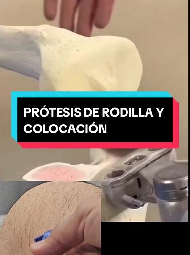 Colocación de prótesis de rodilla: Corte y procedimiento detallado