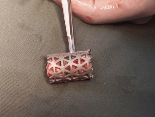 Fractura con aplastamiento traumático de L1.