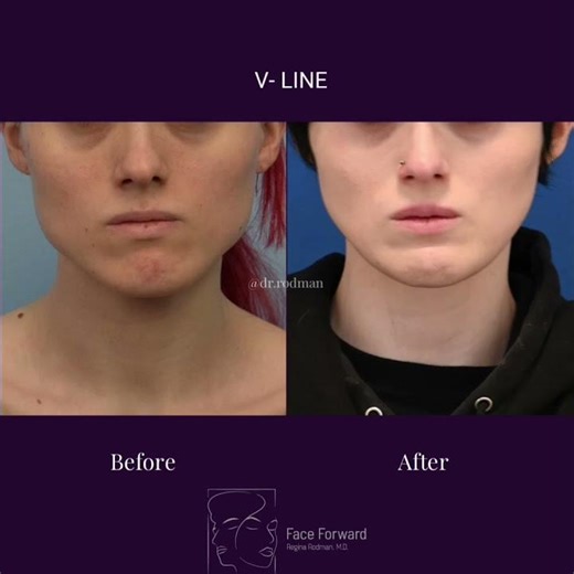 V- Line Results| Before and After| Facial Plastic Surgery