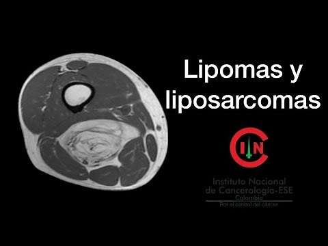 Lipomas y liposarcomas ( Dr. Andrés Rodríguez- U. Rosario)