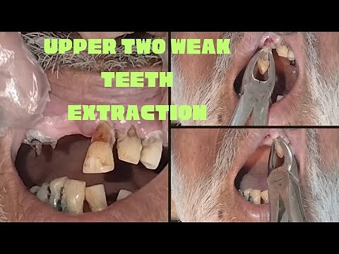 Front upper teeth extraction | Tooth extraction | front tooth extraction