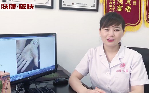 肤康专家在线解析:手癣的治疗方法以及注意事项