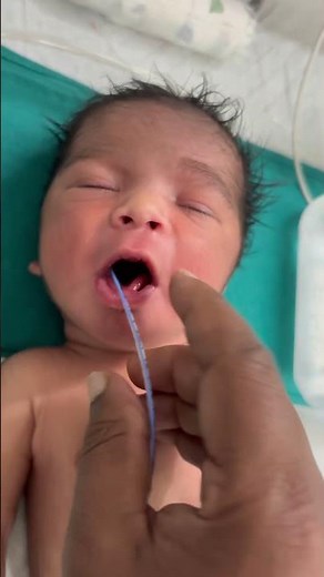 How a Newborn Baby’s NG Tube Is Gently Inserted – Step-by-Step NICU Care #Newborn #NGTubeInsertion