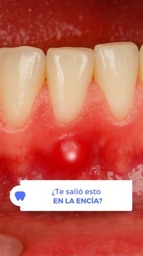 醴 ¿Ves una bolita en la encía? No la ignores. Puede tratarse de una...
