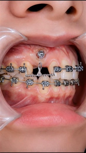 How to pulling out impacted tooth with braces #orthodontist #orthodontics #teeth #dentist #brackets