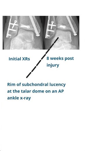 The Hawkin's Sign | Radiographic Sign for Talar Neck Fractures