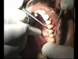 Healiguide (Bio Resorbable GTR/GBR Membrane)