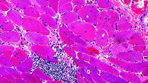 Muscle Weakness Does Not Always Mean Myositis