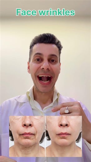 1 exercise for double chin, face sagging , smile line, uneven face and droopy face- Stop againg