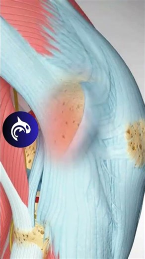 Iliotibial Band Syndrome (ITBS) – Outer Knee Pain? See what can cause it