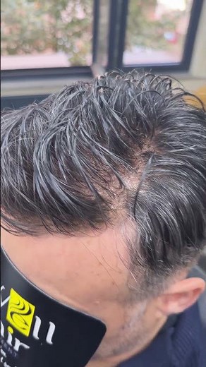 SAÇ EKİMİ DEĞİL! 😲 | Bu Değişim Sizi Şaşırtacak | Hair System Transformation