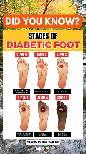 268K views · 455 reactions | Understanding the stages of diabetic foot is crucial for managing this condition. Regular foot exams and proper diabetes management can help prevent progression to advanced stages. Stay informed, stay healthy! #DidYouKnow #diabetic #diabeticfoot #healthandwellness #trendingreelsvideo | Health Spirit Body | Facebook