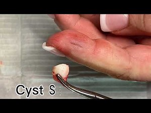Finger Cyst Procedure by Dr. Shafa at OC MedDerm in Irvine, CA #dermatology #dermatologist #cyst