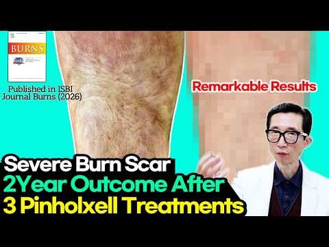 Severe Burn Scar: 2-Year Results After 3 Pinholxell Sessions📌 (Typically ≥5 Sessions Needed)