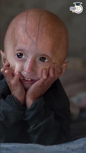 What is Progeria?