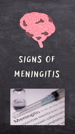 Dr Vishal Gabale | Is Kernig’s and Brudzinski = Meningitis ?? Neurological signs that we must know !! #neurology #medicine #meningitis #meningitis #stroke... | Instagram