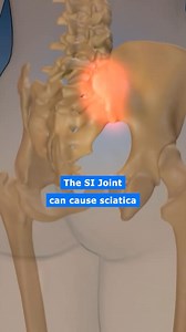 3.6K views · 3.6K reactions | SI joint can cause sciatica ⚡️ The...