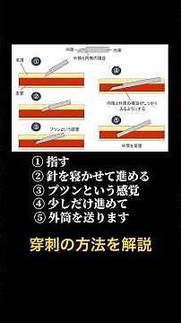 透析の穿刺方法を解説！