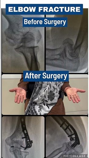 Full Recovery After Complex Elbow Fracture Surgery