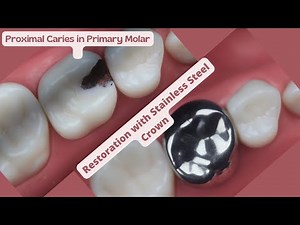 How To Restore Primary Molar with Proximal Caries 🟢 Stainless Steel Crown Restoration 🟡 3 Steps